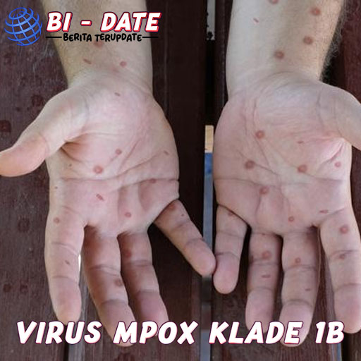 Virus Mpox Klade 1b